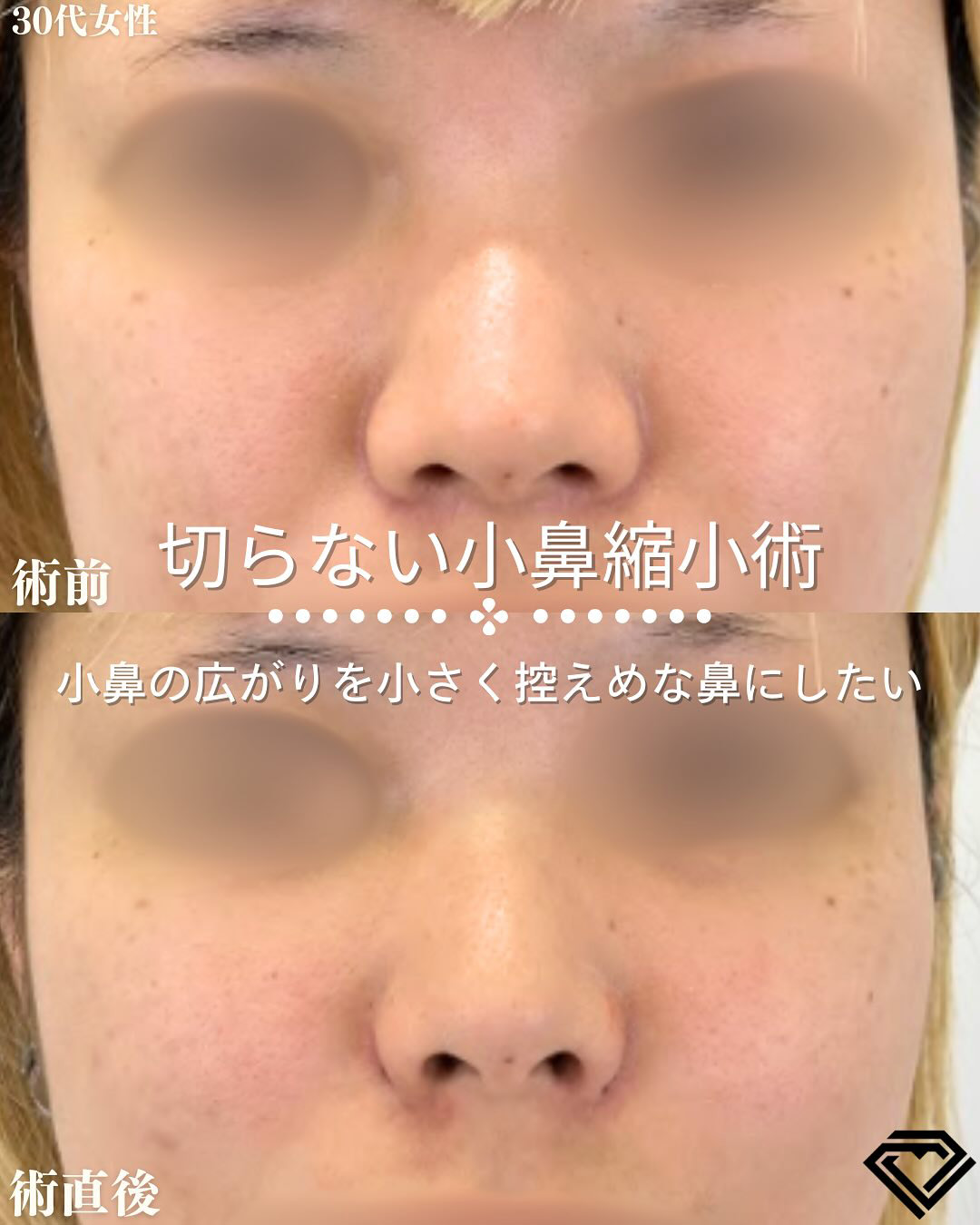 切らない小鼻縮小の症例写真01