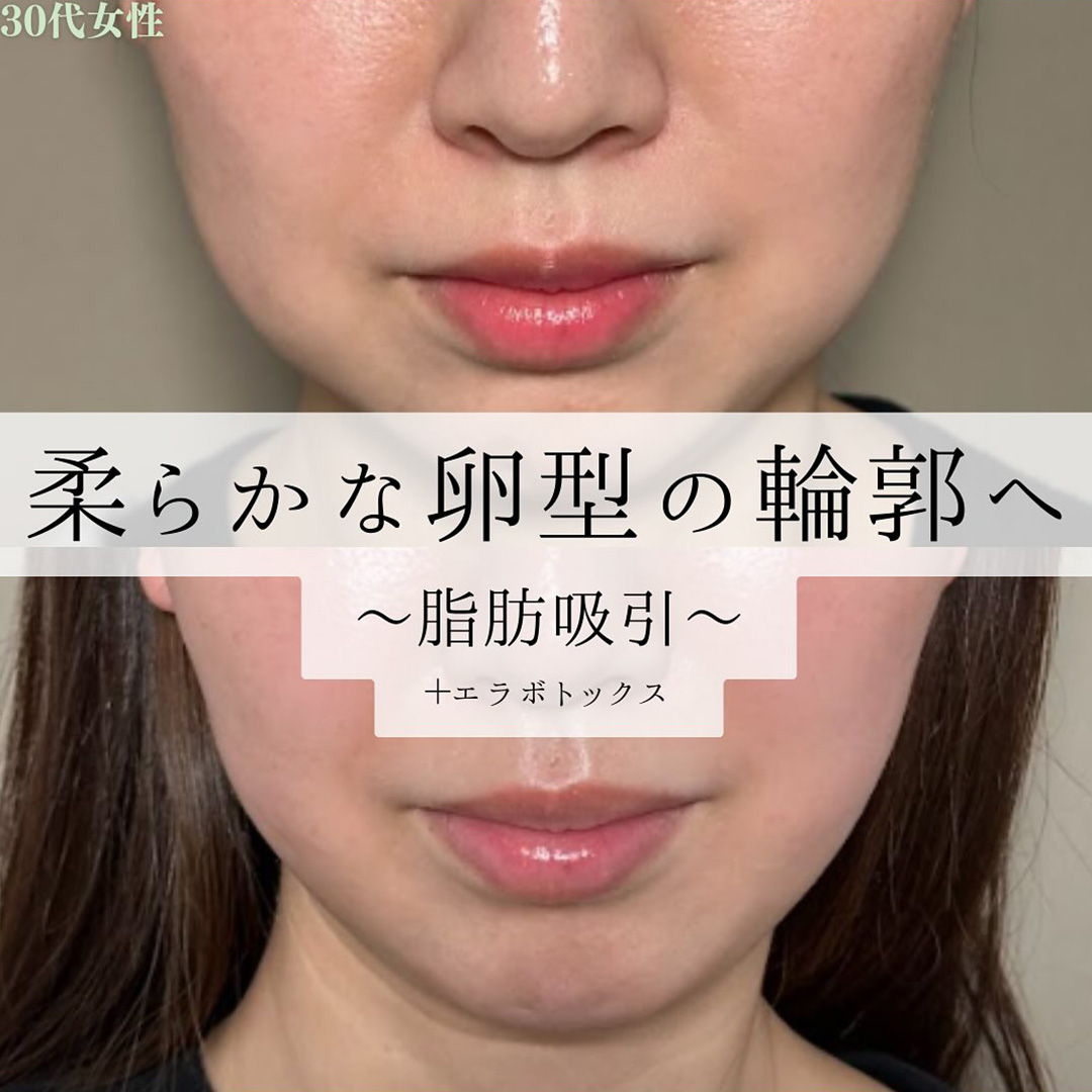 顔の脂肪吸引の症例写真01