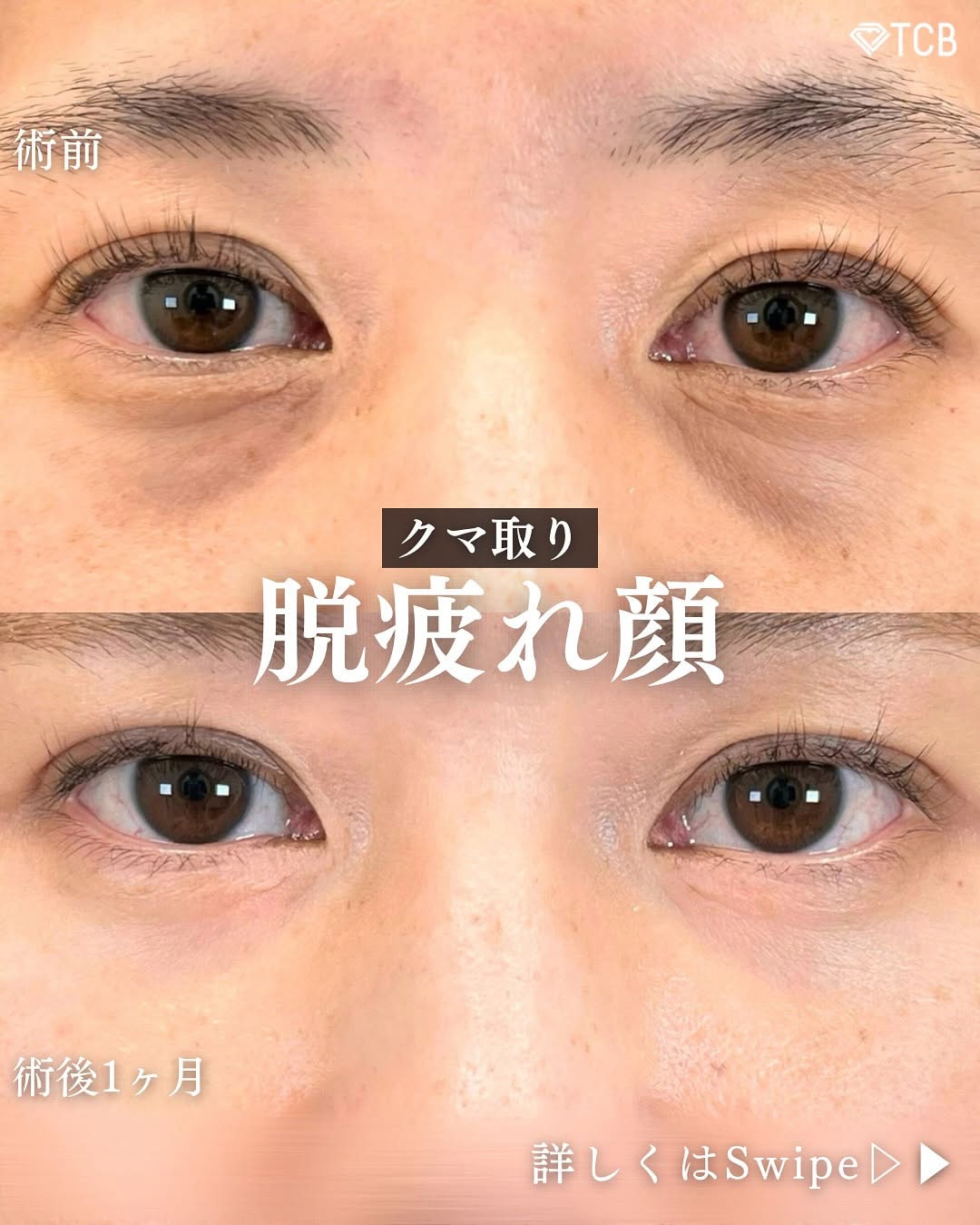 切らない目の下のクマ取り・目の下のたるみ（ふくらみ）取りの症例写真01