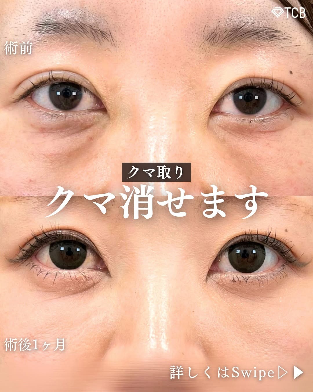 切らない目の下のクマ取り・目の下のたるみ（ふくらみ）取りの症例写真02