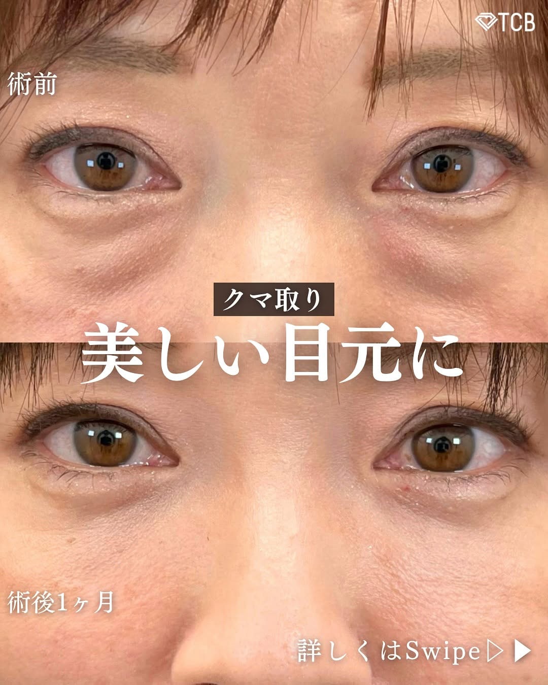 切らない目の下のクマ取り・目の下のたるみ（ふくらみ）取りの症例写真03