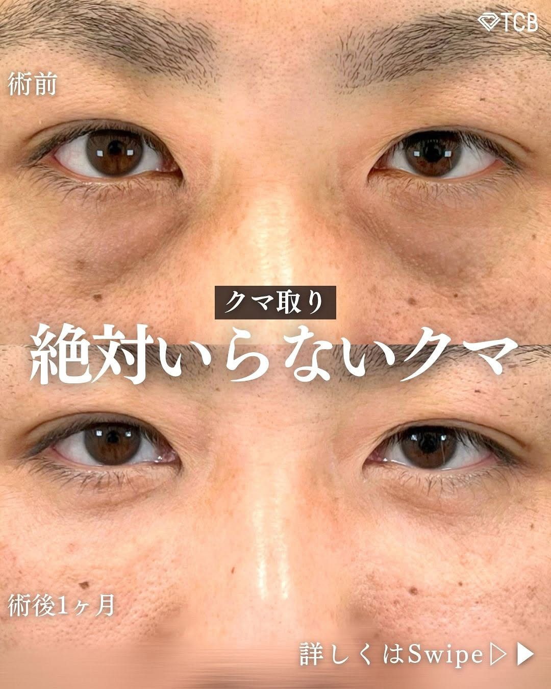 切らない目の下のクマ取り・目の下のたるみ（ふくらみ）取りの症例写真04