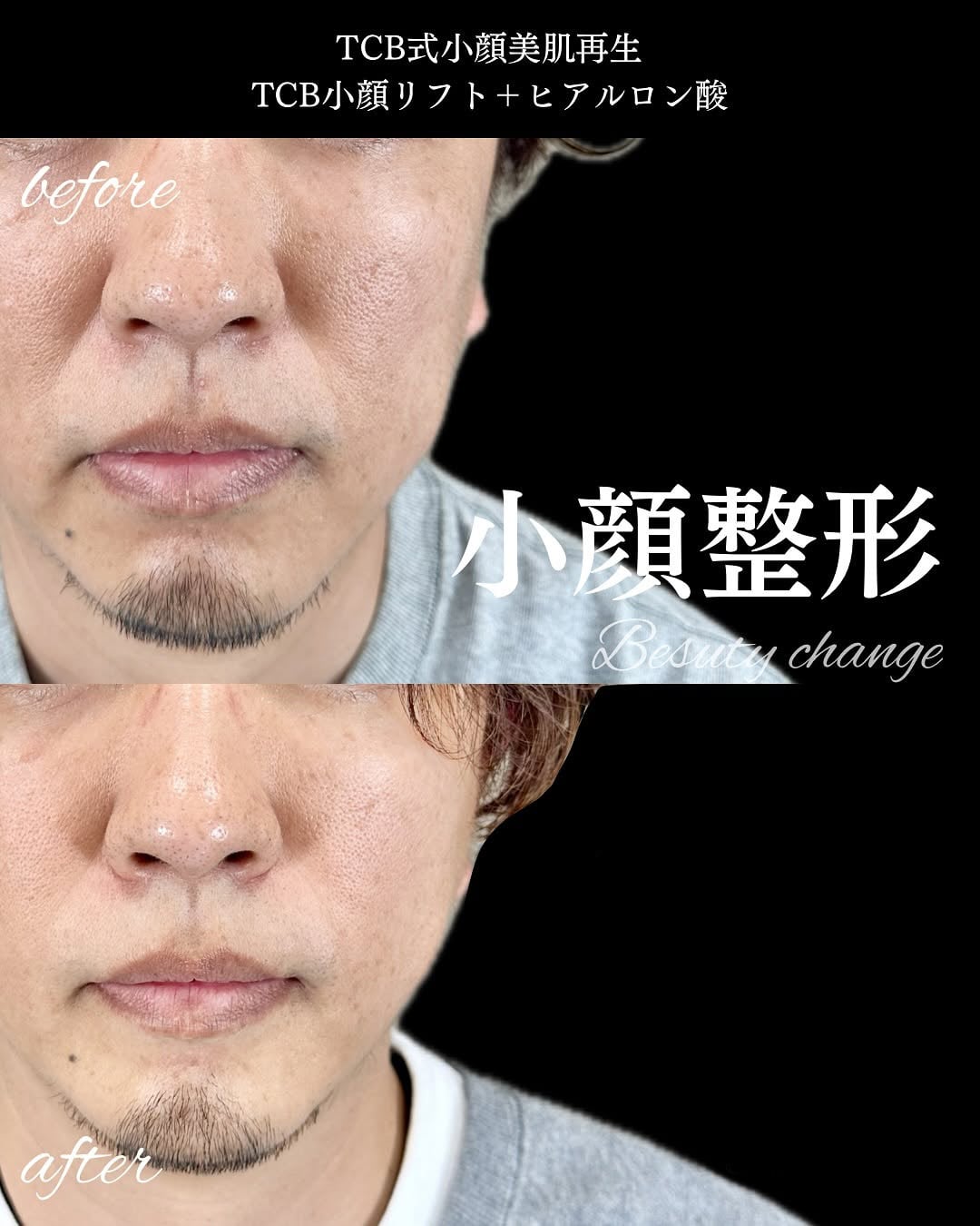 小顔美肌再生の症例写真01