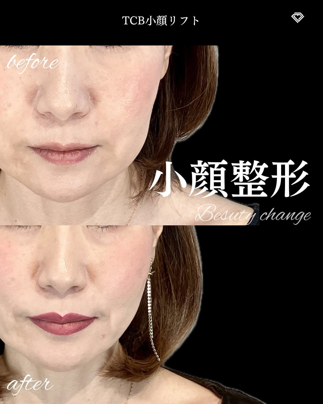 小顔美肌再生の症例写真02