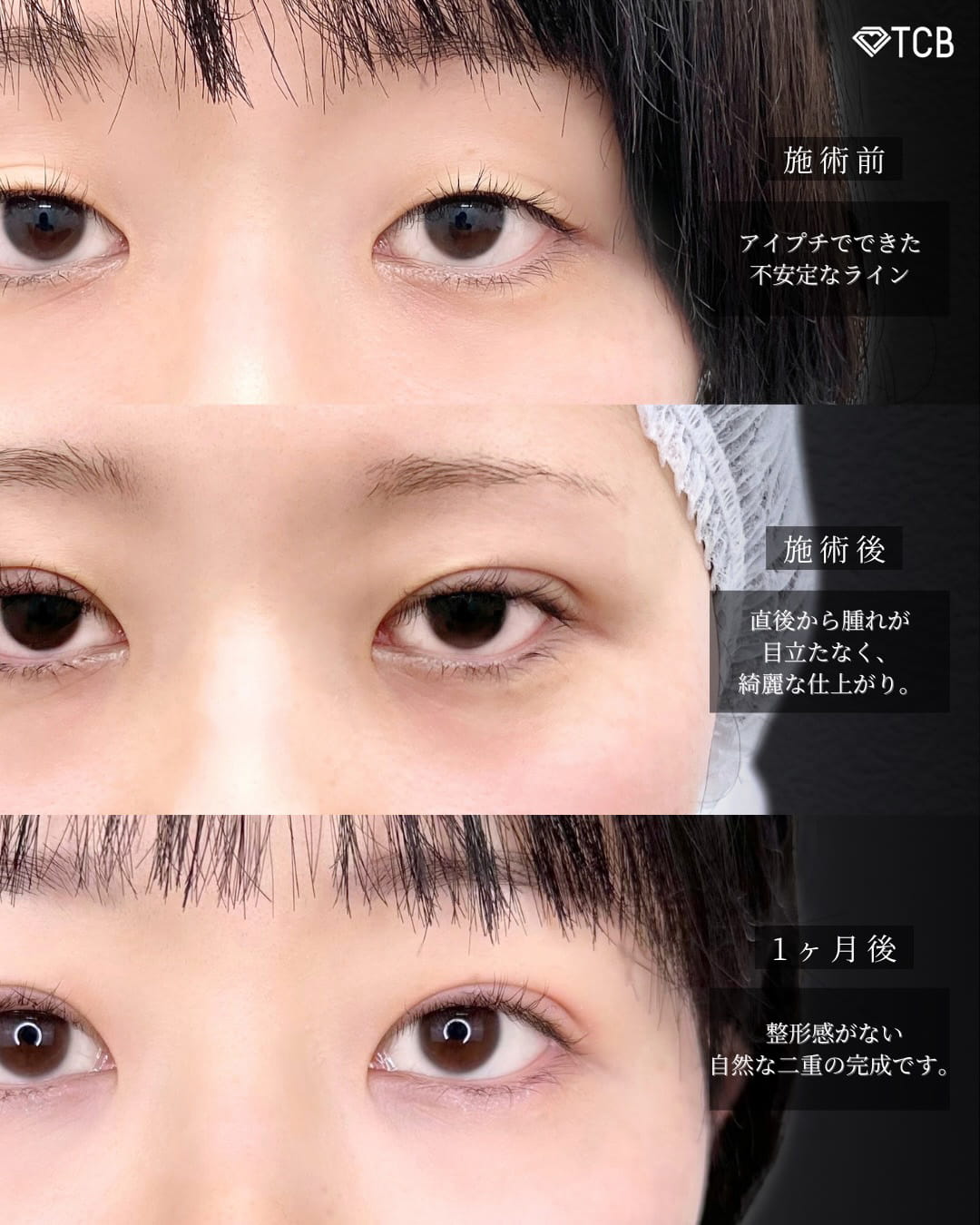 二重埋没の症例写真01