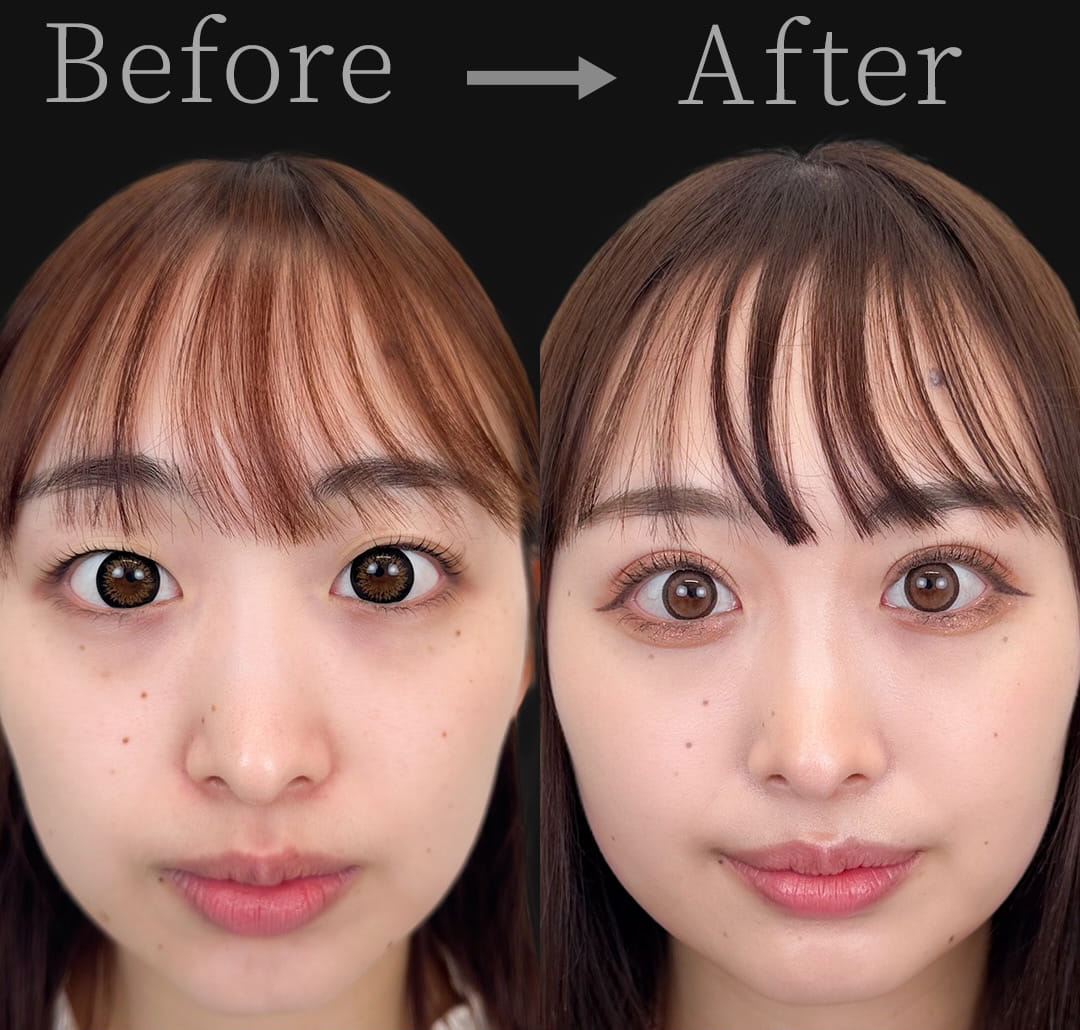 二重埋没の症例写真02