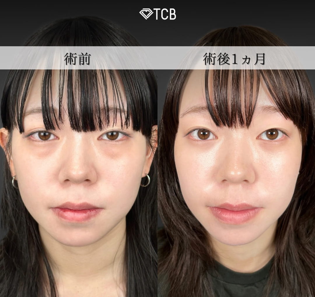 皮膚を切らない目の下のクマ取り・たるみ（ふくらみ）取りの症例写真01