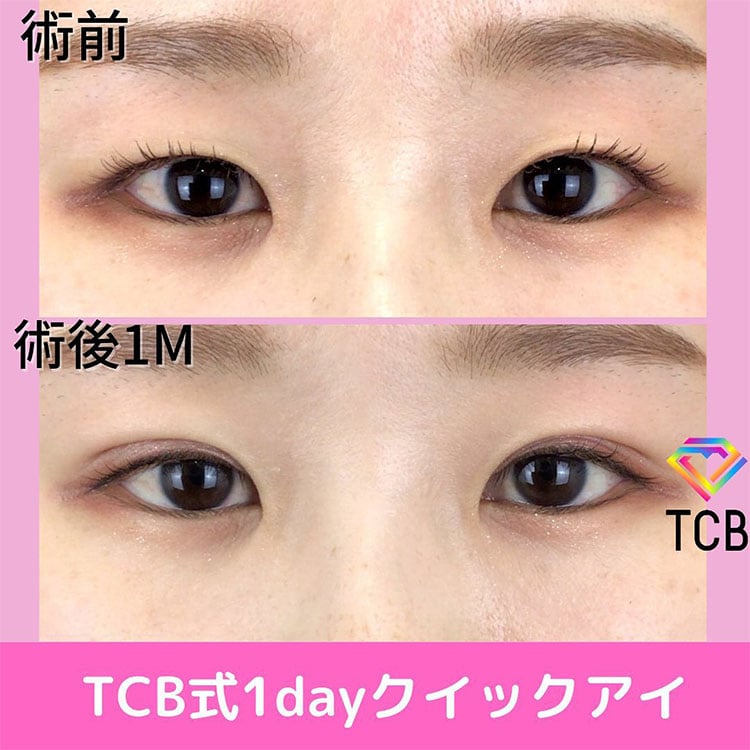 二重埋没の症例写真01