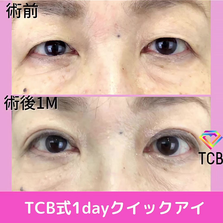 二重埋没の症例写真02