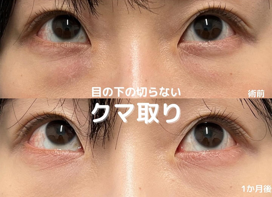 切らない目の下のクマ取り・目の下のたるみ（ふくらみ）取りの症例写真01