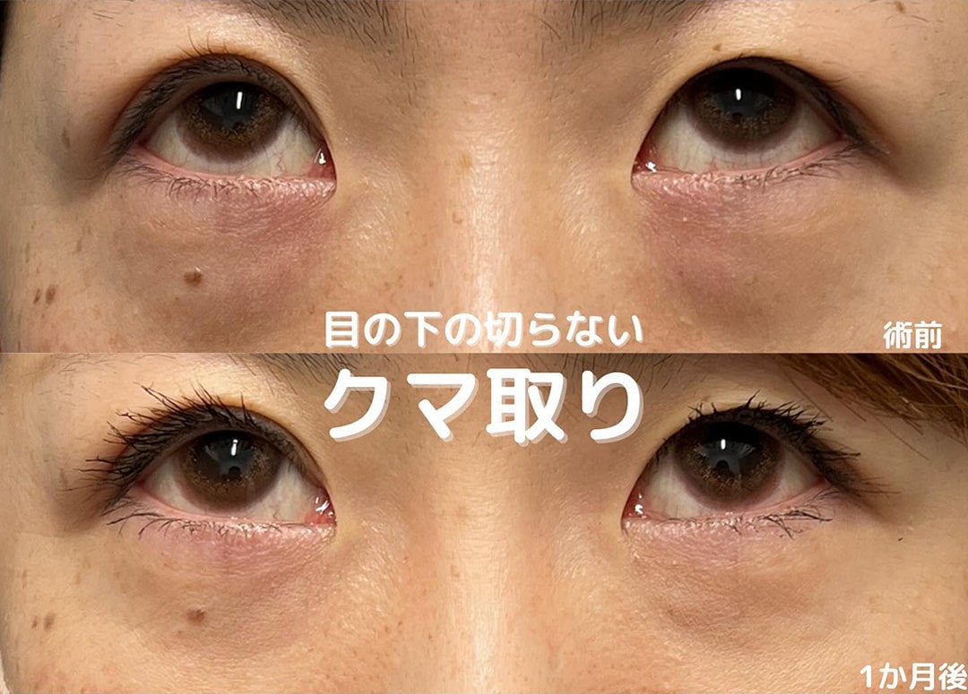 切らない目の下のクマ取り・目の下のたるみ（ふくらみ）取りの症例写真02
