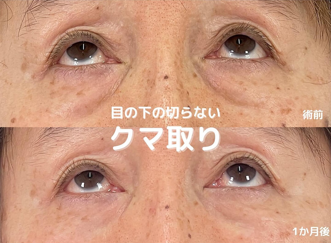 切らない目の下のクマ取り・目の下のたるみ（ふくらみ）取りの症例写真03