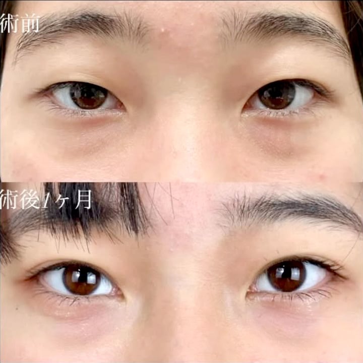 二重埋没の症例写真02