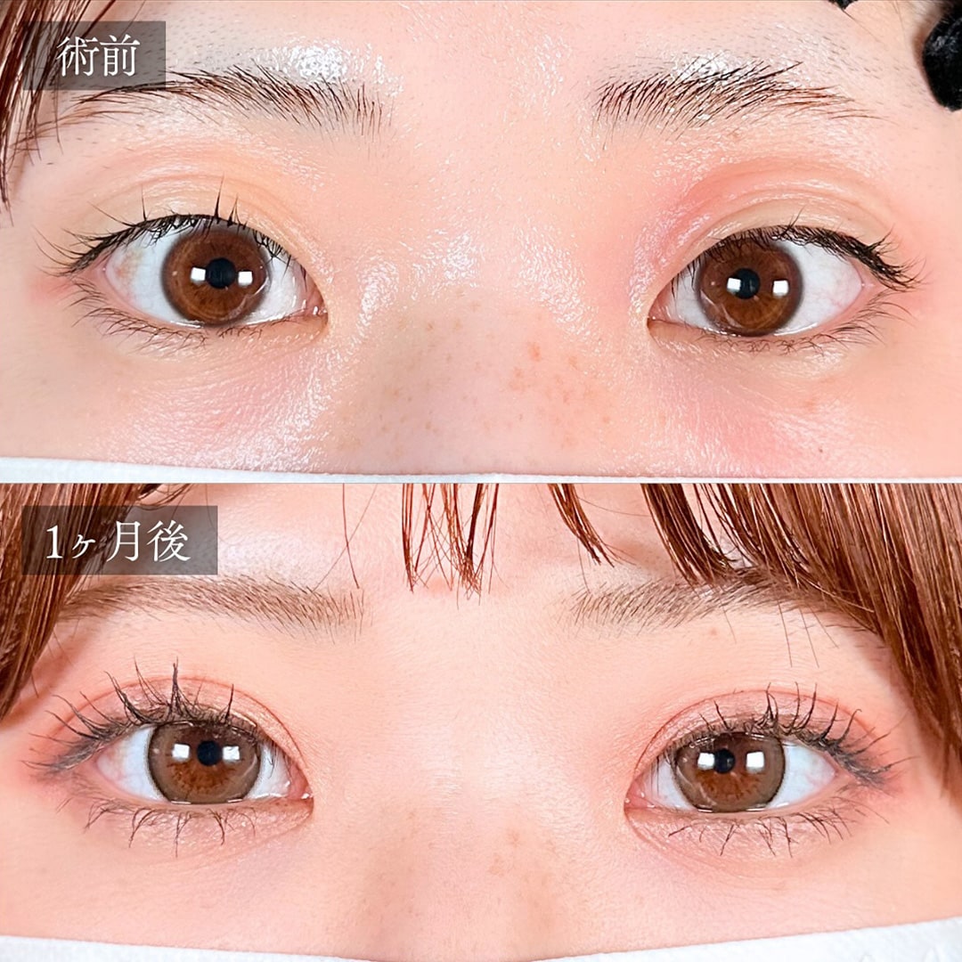 二重埋没の症例写真01