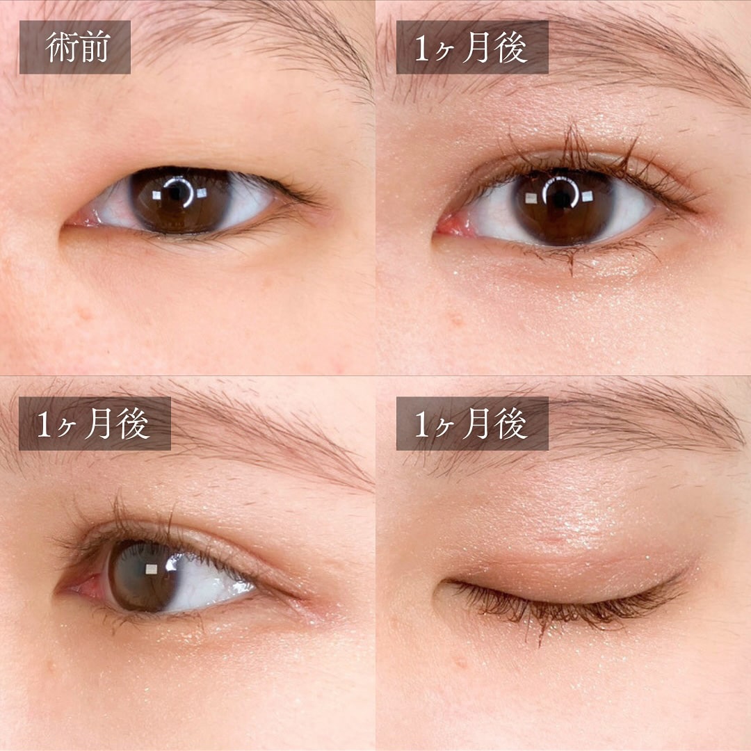 二重埋没の症例写真02