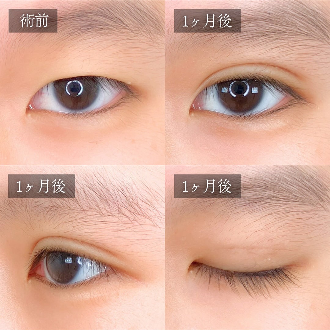 二重埋没の症例写真03