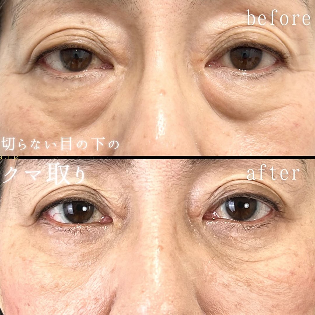 切らない目の下のクマ取り・目の下のたるみ（ふくらみ）取りの症例写真01