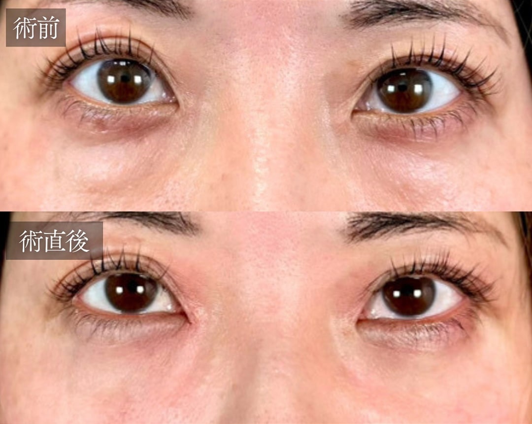 切らない目の下のクマ取り・目の下のたるみ（ふくらみ）取りの症例写真02