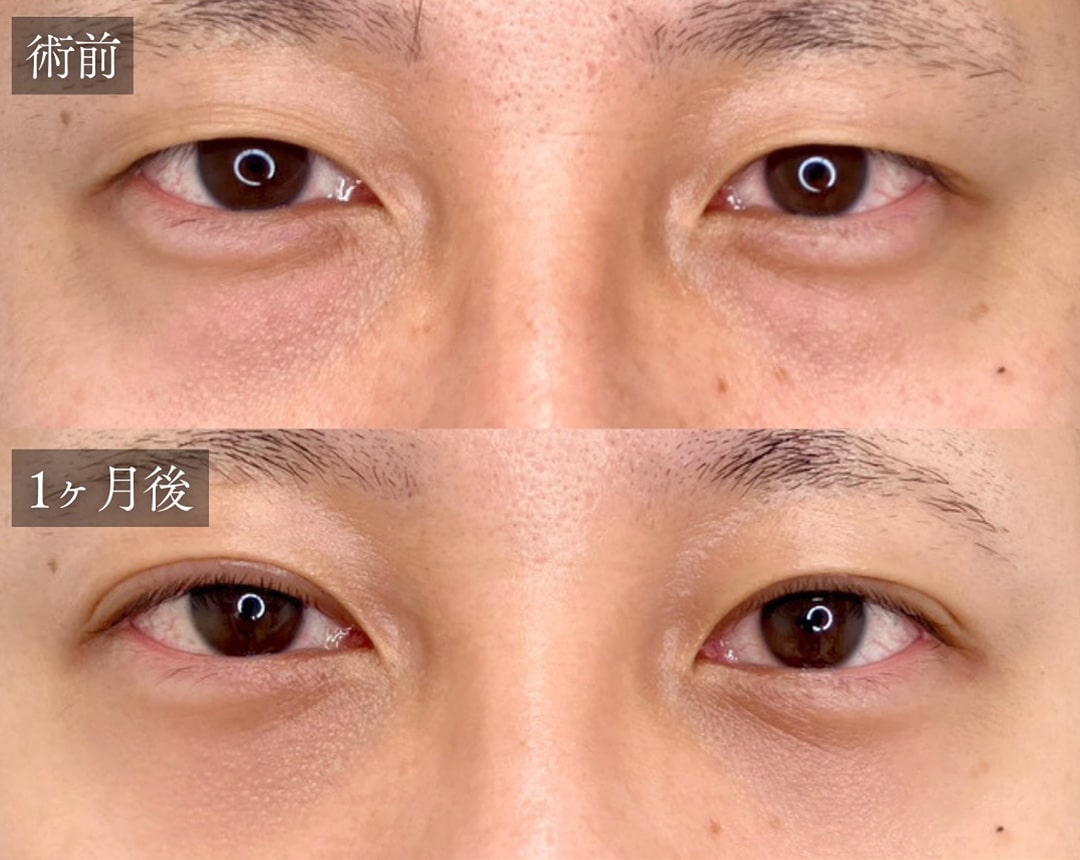 切らない目の下のクマ取り・目の下のたるみ（ふくらみ）取りの症例写真03