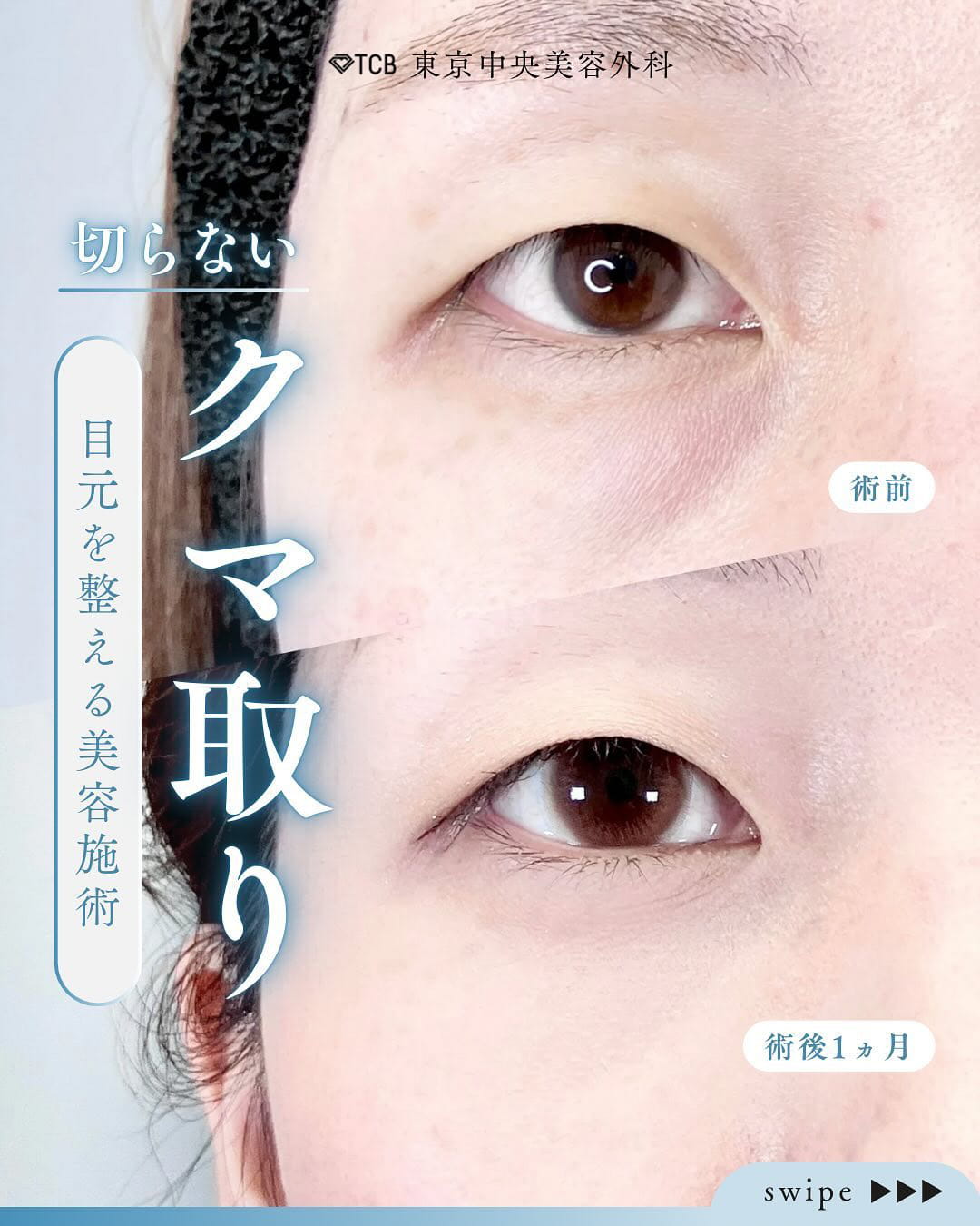 切らない目の下のクマ取り・目の下のたるみ（ふくらみ）取りの症例写真01