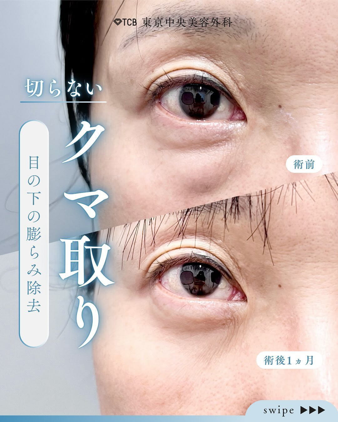 切らない目の下のクマ取り・目の下のたるみ（ふくらみ）取りの症例写真02