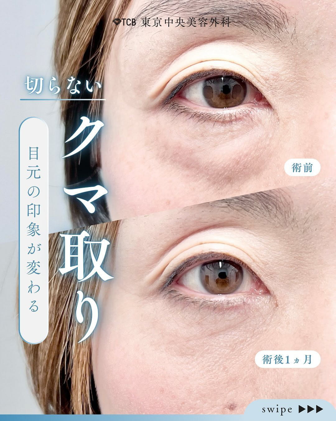 切らない目の下のクマ取り・目の下のたるみ（ふくらみ）取りの症例写真03