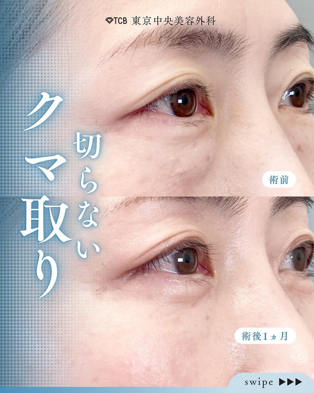 切らない目の下のクマ取り・目の下のたるみ（ふくらみ）取りの症例写真05