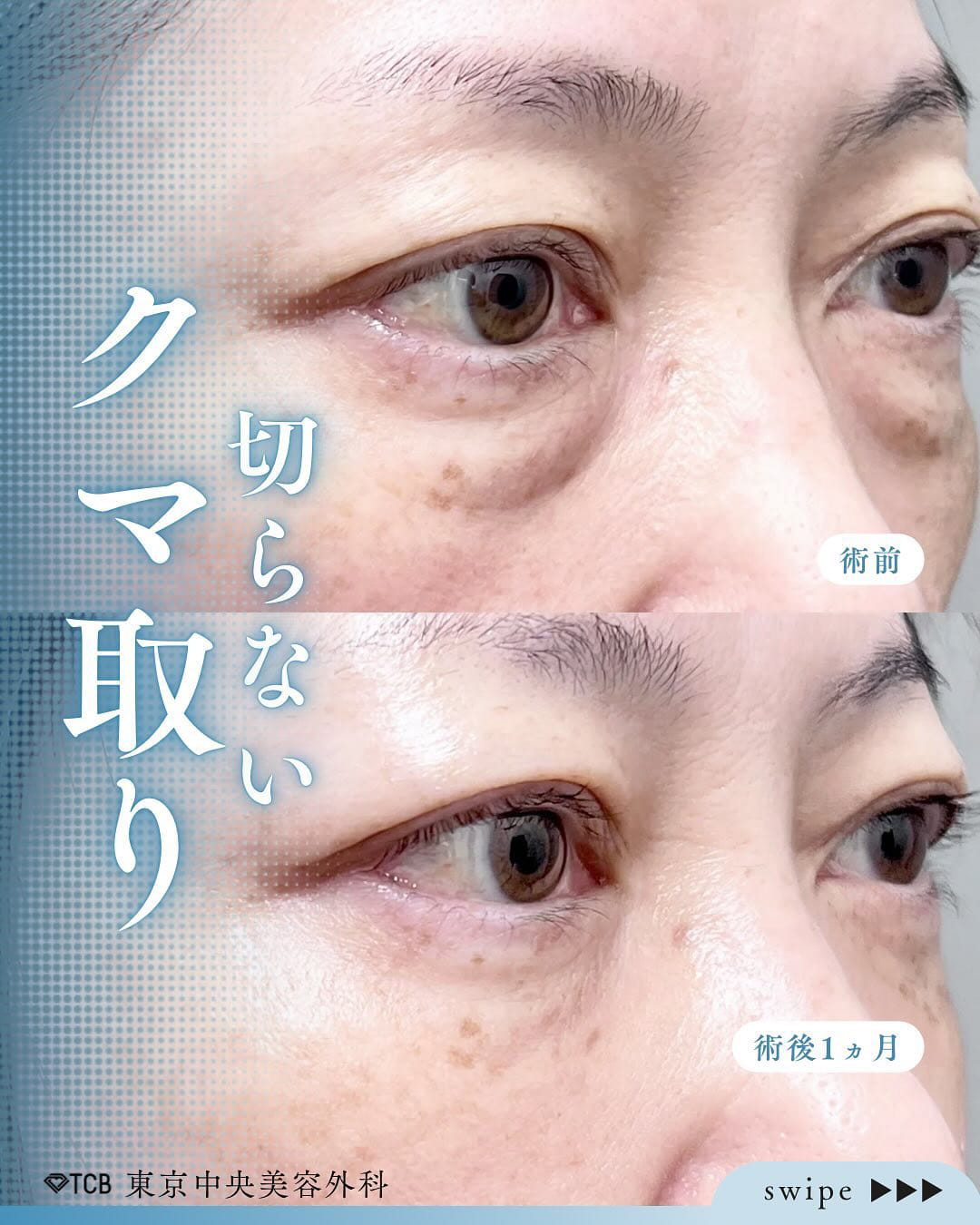 切らない目の下のクマ取り・目の下のたるみ（ふくらみ）取りの症例写真06