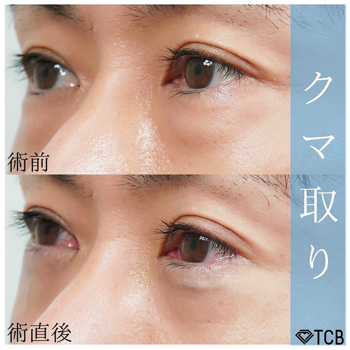 切らない目の下のクマ取り・目の下のたるみ（ふくらみ）取りの症例写真01