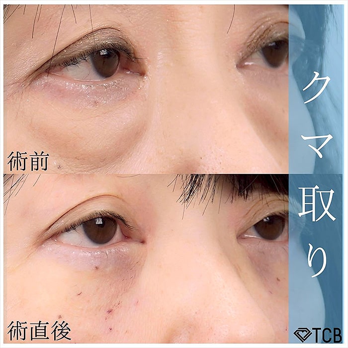 切らない目の下のクマ取り・目の下のたるみ（ふくらみ）取りの症例写真03