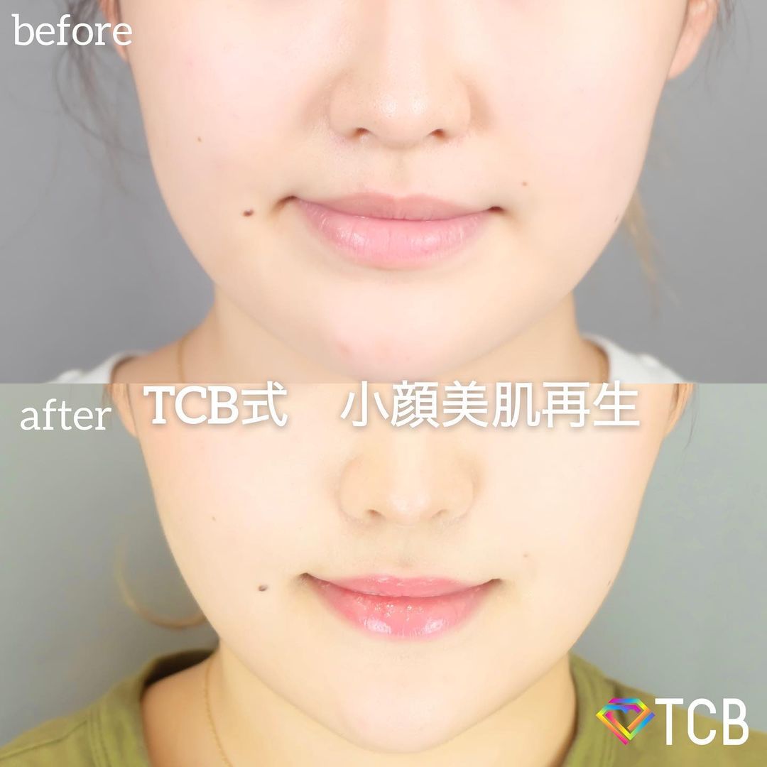 小顔美肌再生の症例写真01
