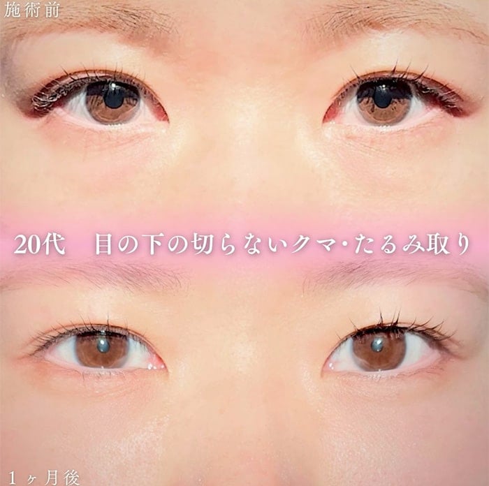 切らない目の下のクマ取り・目の下のたるみ（ふくらみ）取りの症例写真01