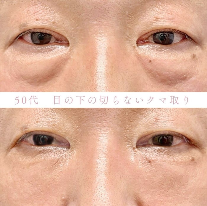 切らない目の下のクマ取り・目の下のたるみ（ふくらみ）取りの症例写真05