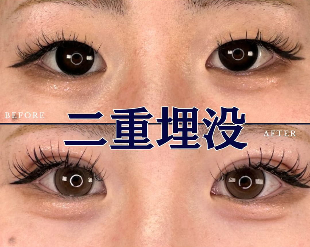 二重埋没の症例写真01