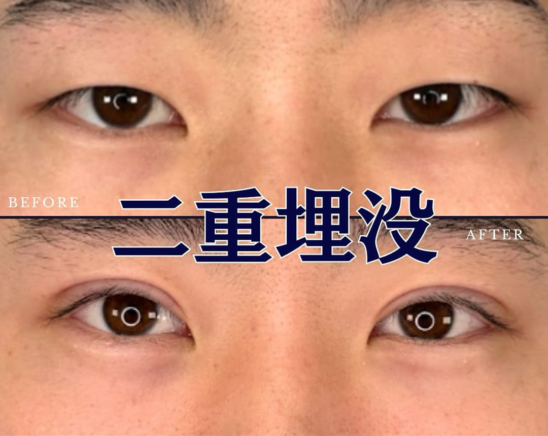二重埋没の症例写真02