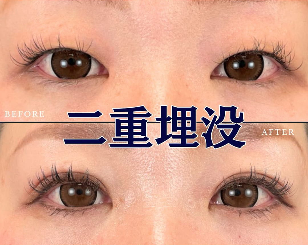 二重埋没の症例写真03