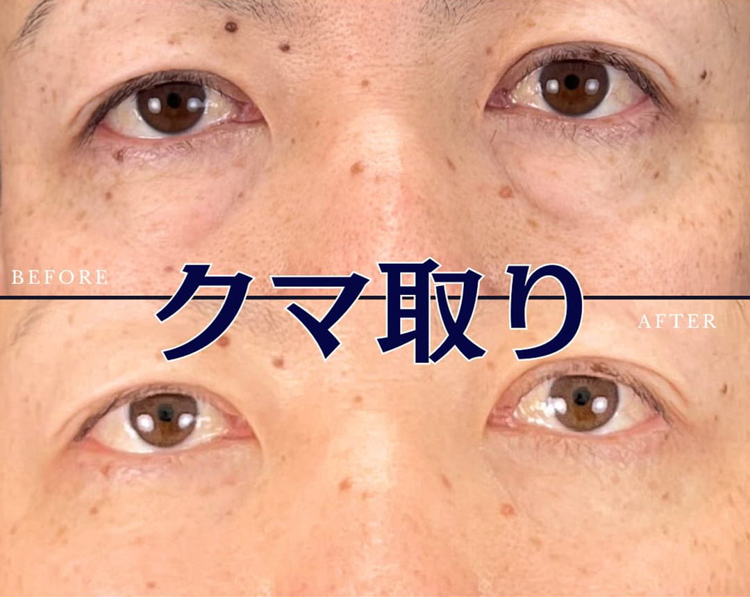 皮膚を切らない目の下のクマ取り・たるみ（ふくらみ）取りの症例写真01
