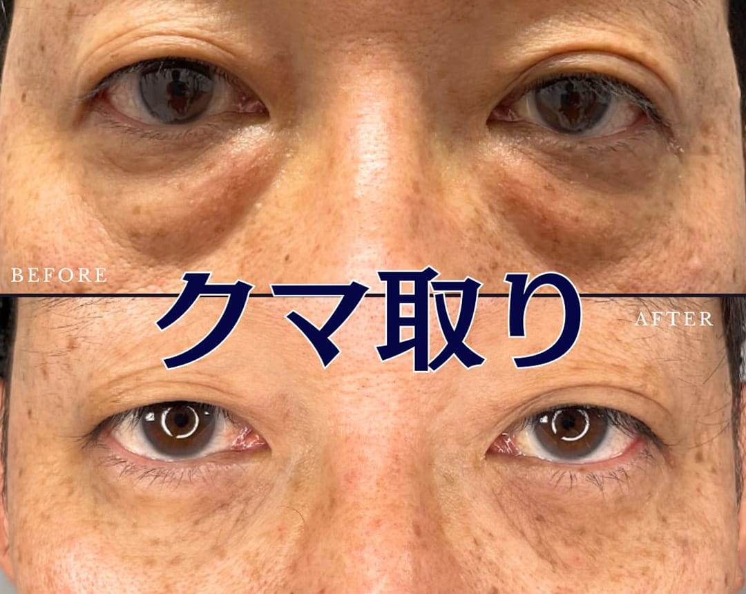 皮膚を切らない目の下のクマ取り・たるみ（ふくらみ）取りの症例写真02