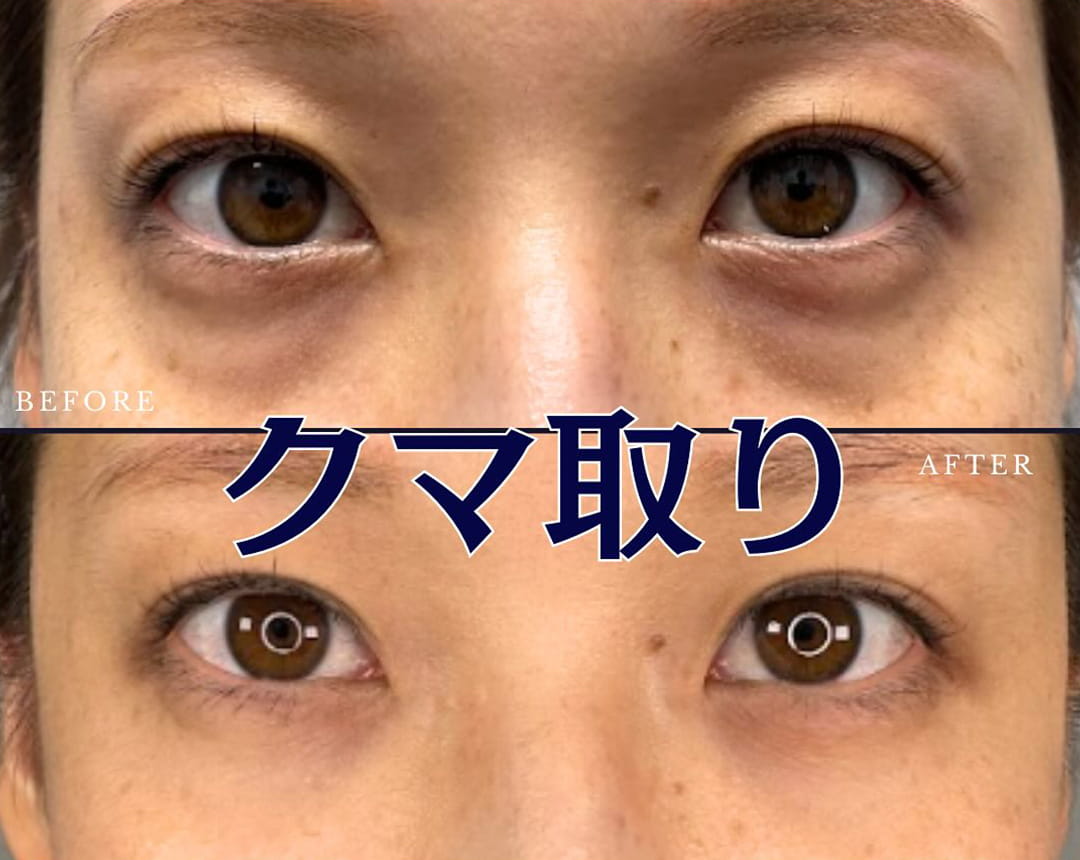 皮膚を切らない目の下のクマ取り・たるみ（ふくらみ）取りの症例写真03