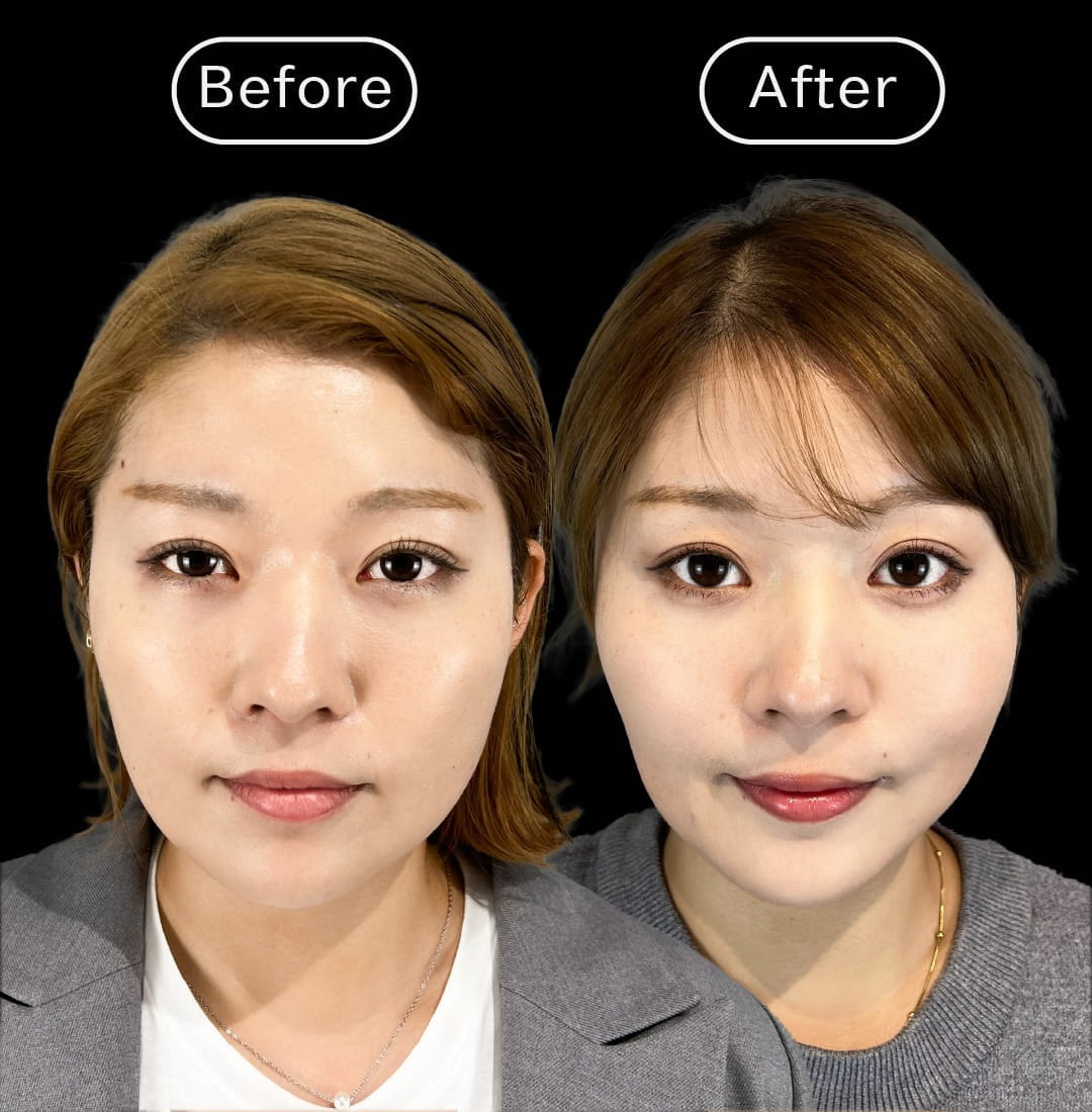 顔の脂肪吸引の症例写真01