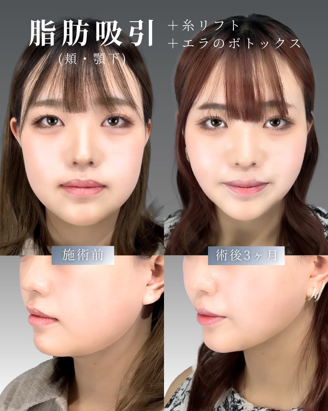 顔の脂肪吸引の症例写真02