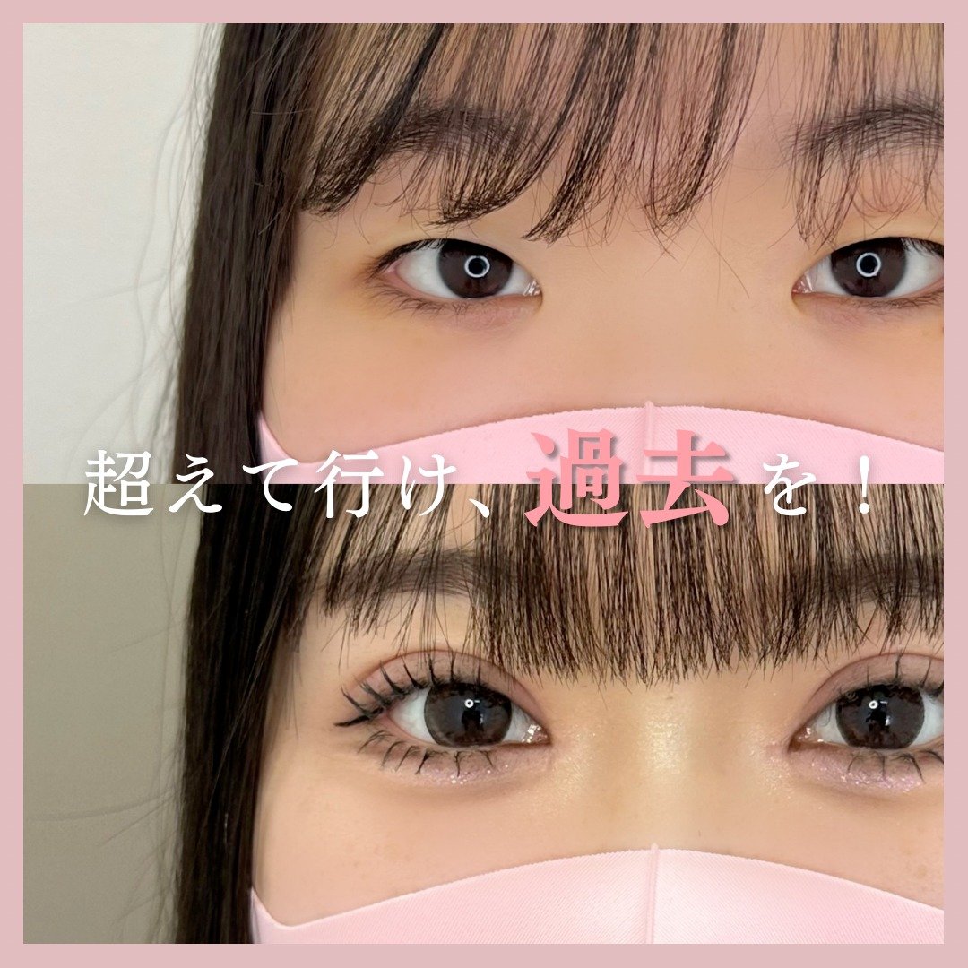 二重埋没の症例写真01
