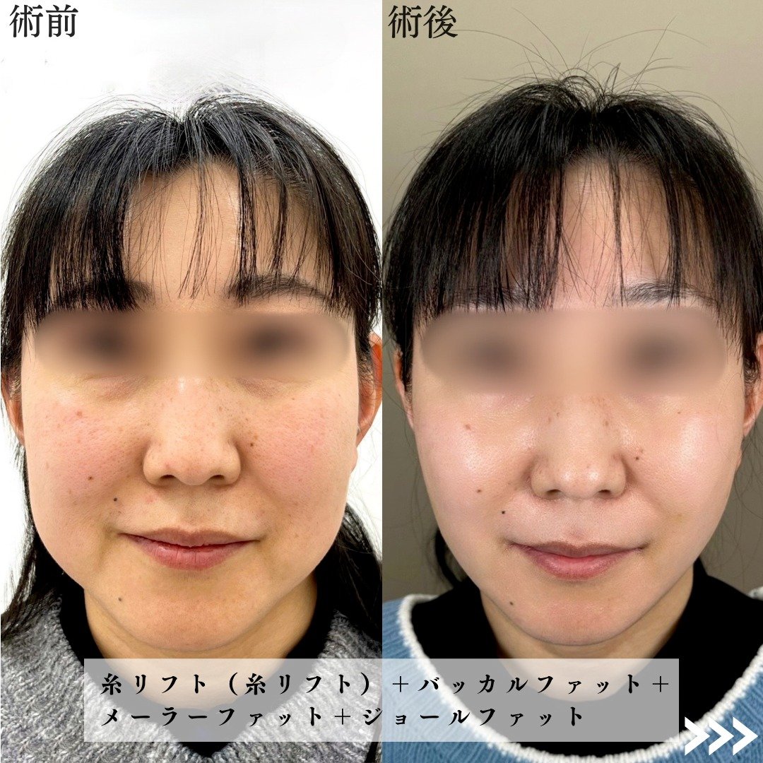 TCB小顔リフトの症例写真01