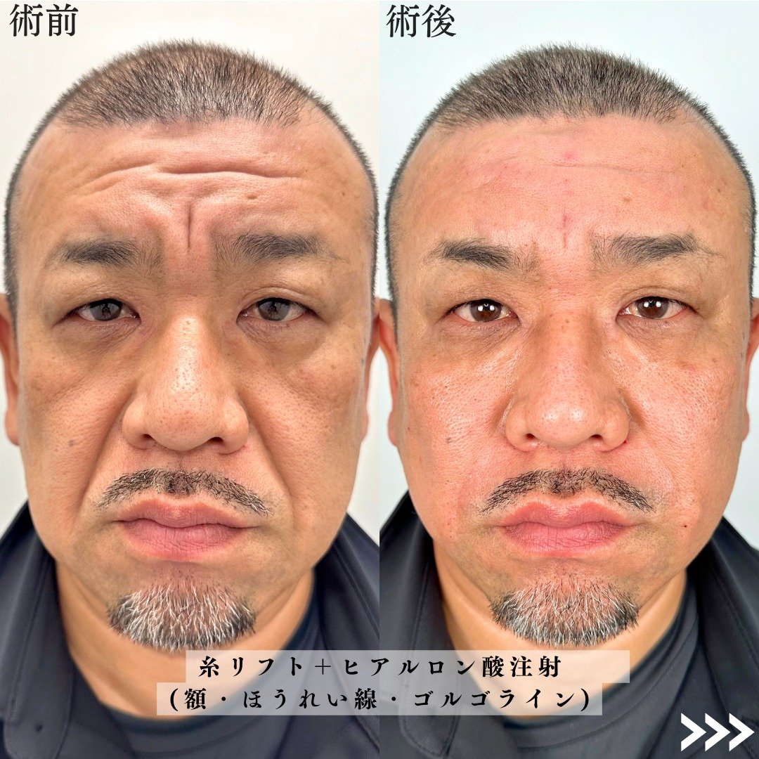 小顔美肌再生の症例写真01