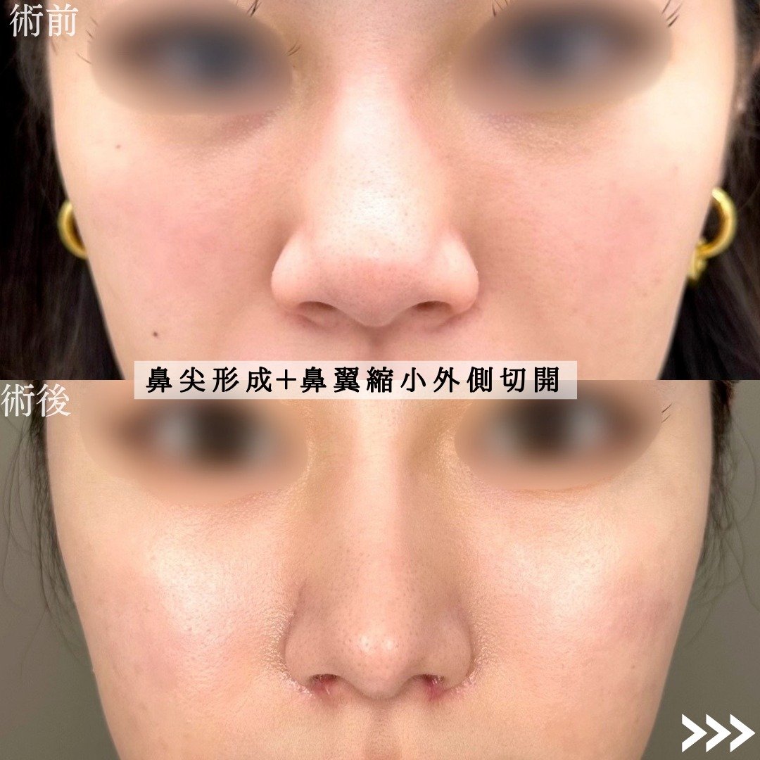 TCB鼻尖形成の症例写真01