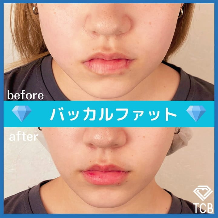 バッカルファット除去の症例写真01