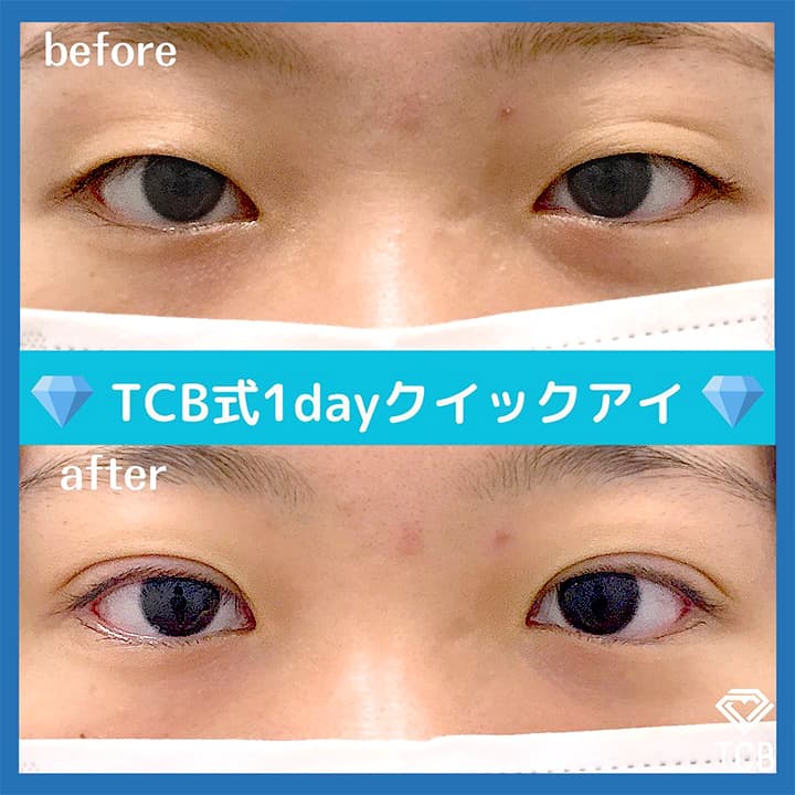 二重埋没の症例写真01