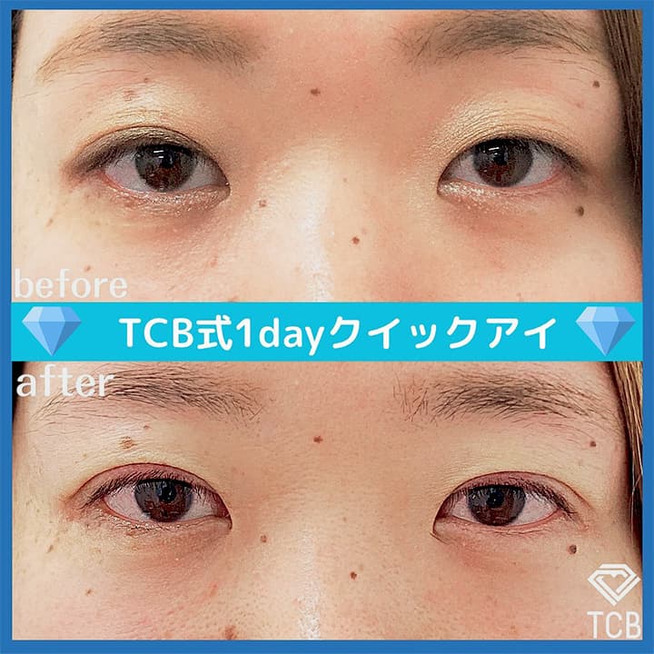 二重埋没の症例写真02