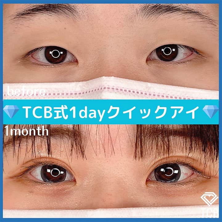 二重埋没の症例写真03