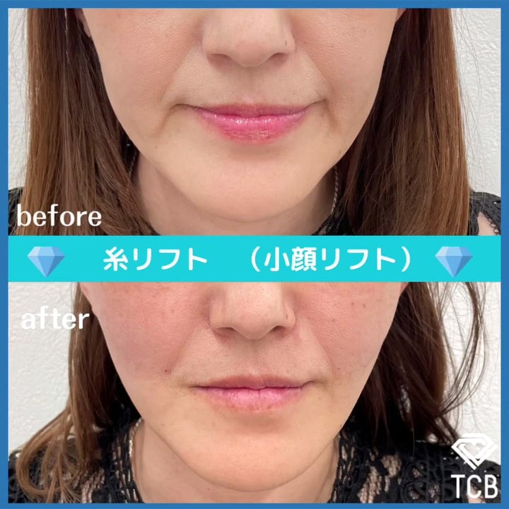 TCB小顔リフトの症例写真01